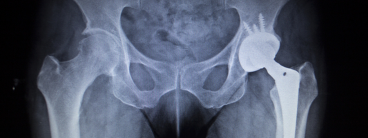 The Nutrition Factor in PJI: Prevent Problems Before Surgery, Recover Stronger After