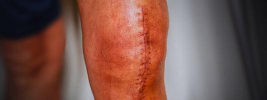 How to Beat Joint Infections Before They Start — and Recover Stronger If They Do