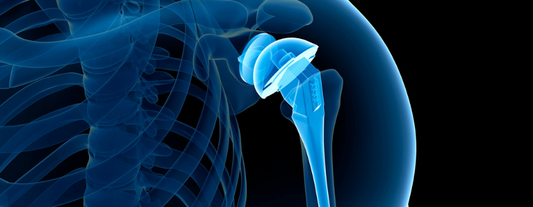 Optimizing Total Shoulder Replacement Surgery Recovery