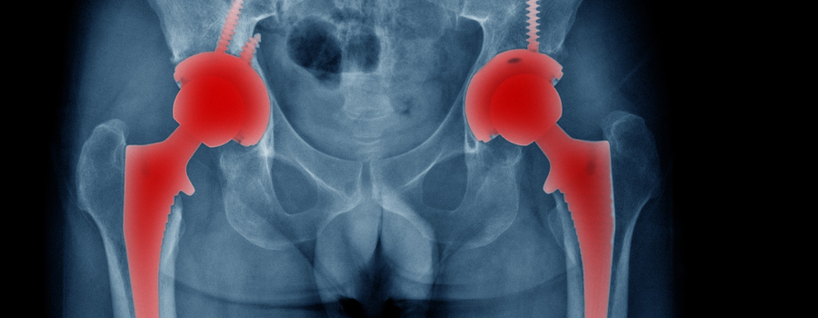 How To Optimize Total Hip Replacement Surgery Recovery