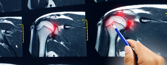 Nutritional Strategies For Optimizing Rotator Cuff Surgery Recovery