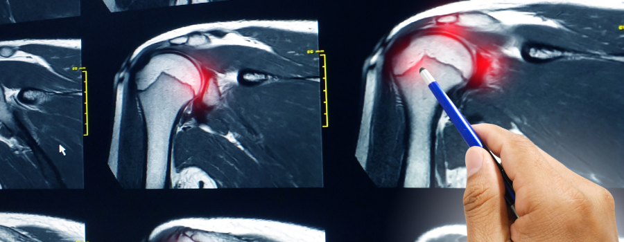 rotator cuff repair